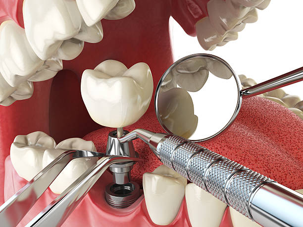 Best Emergency Dentist for Lost Fillings or Crowns in Benld, IL